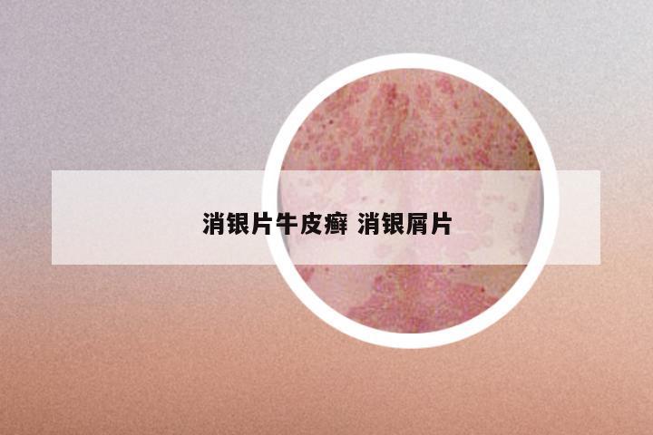 消银片牛皮癣 消银屑片