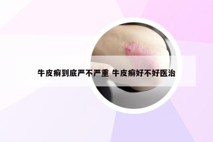 牛皮癣到底严不严重 牛皮癣好不好医治