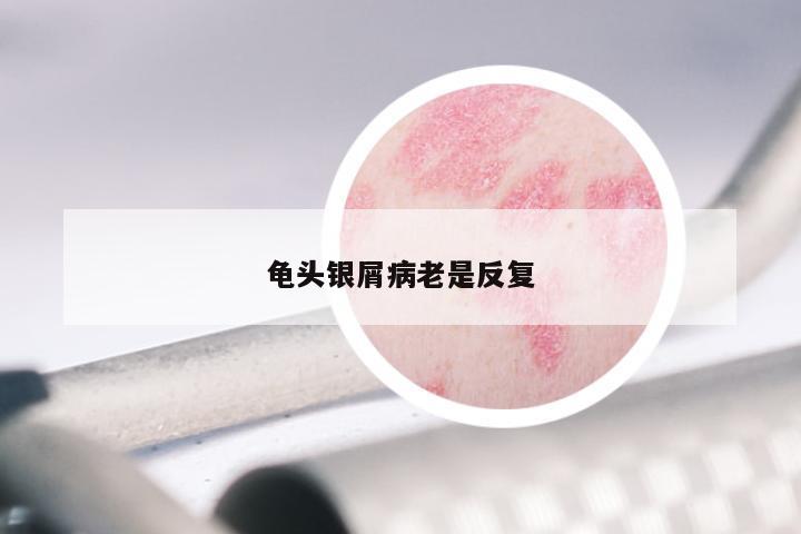 龟头银屑病老是反复