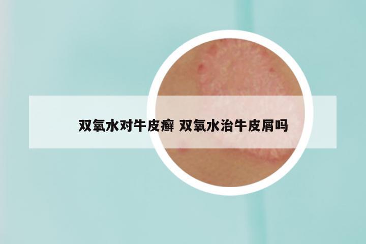 双氧水对牛皮癣 双氧水治牛皮屑吗
