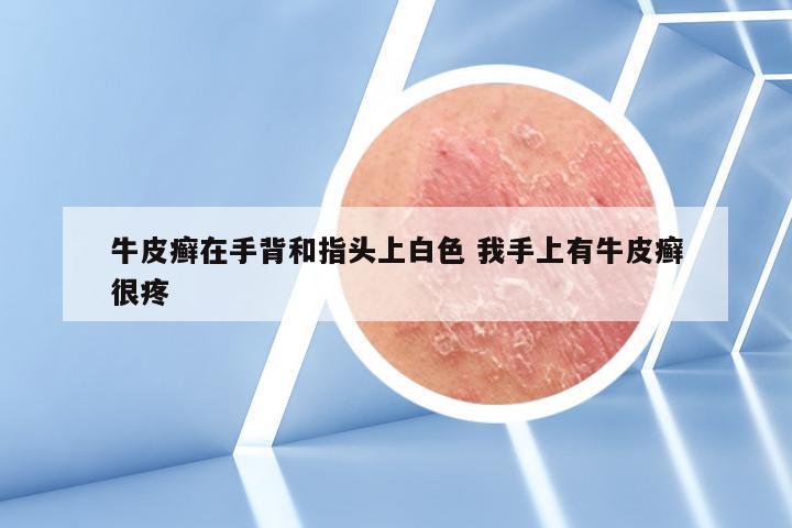 牛皮癣在手背和指头上白色 我手上有牛皮癣很疼