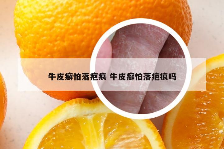 牛皮癣怕落疤痕 牛皮癣怕落疤痕吗