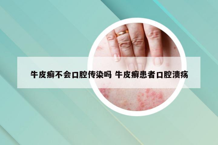 牛皮癣不会口腔传染吗 牛皮癣患者口腔溃疡