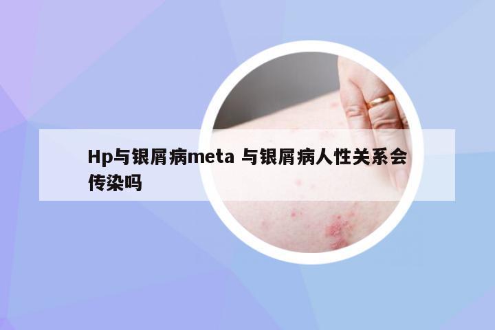 Hp与银屑病meta 与银屑病人性关系会传染吗