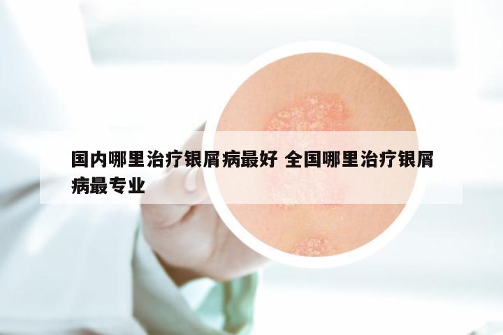 国内哪里治疗银屑病最好 全国哪里治疗银屑病最专业