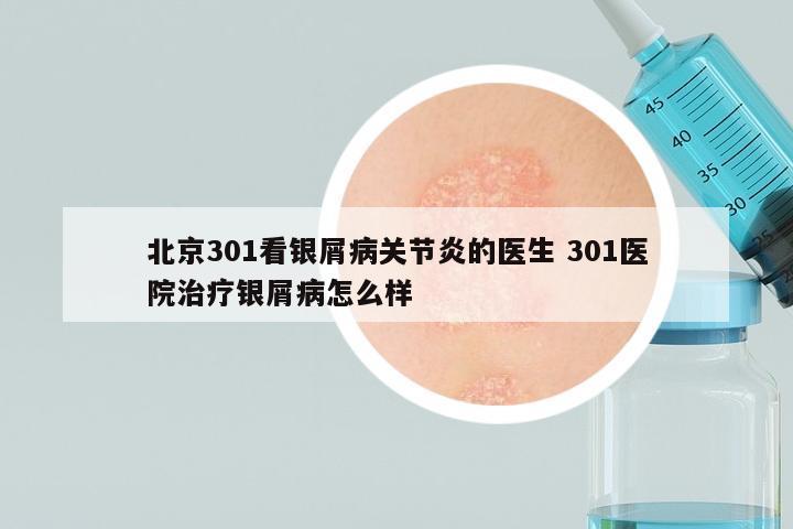 北京301看银屑病关节炎的医生 301医院治疗银屑病怎么样