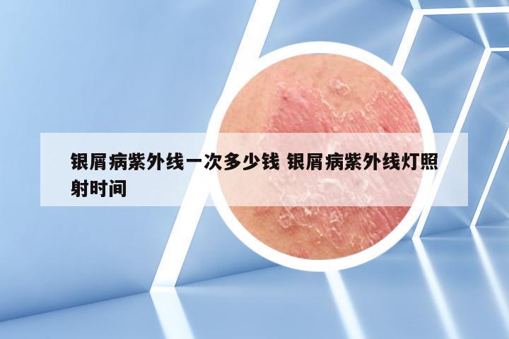 银屑病紫外线一次多少钱 银屑病紫外线灯照射时间