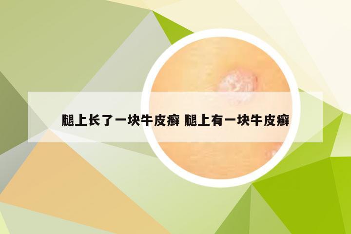 腿上长了一块牛皮癣 腿上有一块牛皮癣
