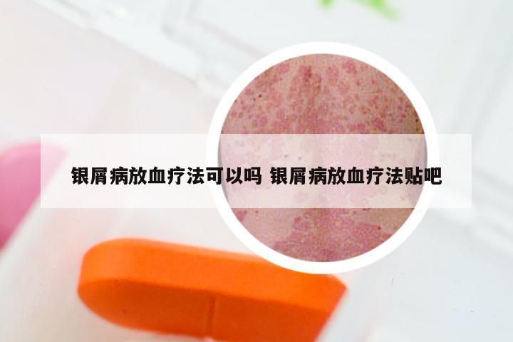 银屑病放血疗法可以吗 银屑病放血疗法贴吧