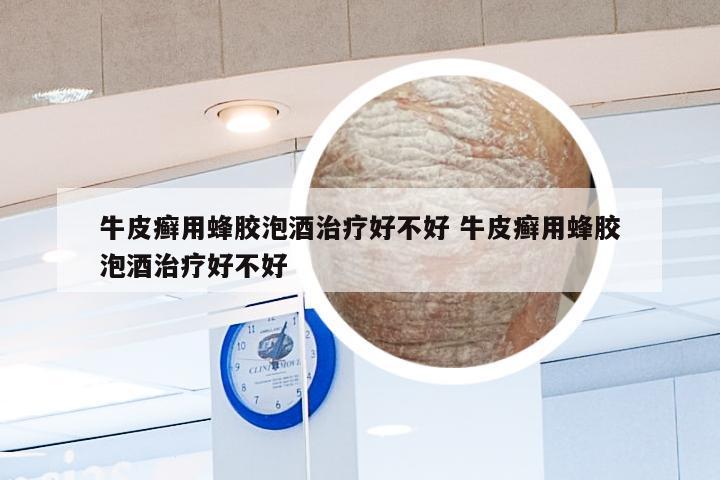 牛皮癣用蜂胶泡酒治疗好不好 牛皮癣用蜂胶泡酒治疗好不好