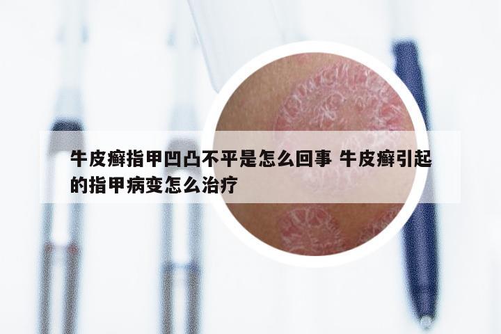 牛皮癣指甲凹凸不平是怎么回事 牛皮癣引起的指甲病变怎么治疗