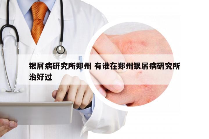 银屑病研究所郑州 有谁在郑州银屑病研究所治好过