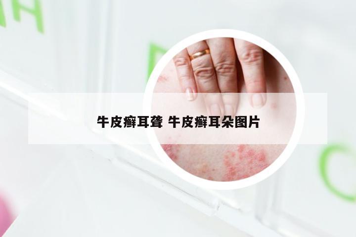 牛皮癣耳聋 牛皮癣耳朵图片