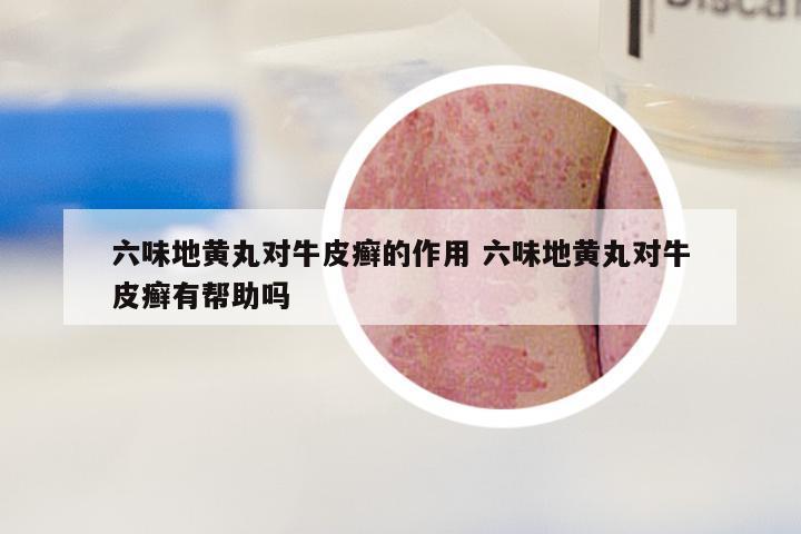 六味地黄丸对牛皮癣的作用 六味地黄丸对牛皮癣有帮助吗
