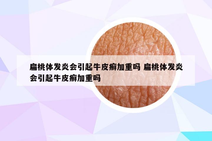 扁桃体发炎会引起牛皮癣加重吗 扁桃体发炎会引起牛皮癣加重吗