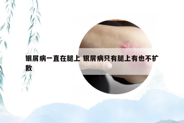 银屑病一直在腿上 银屑病只有腿上有也不扩散