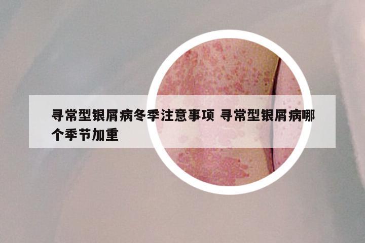 寻常型银屑病冬季注意事项 寻常型银屑病哪个季节加重