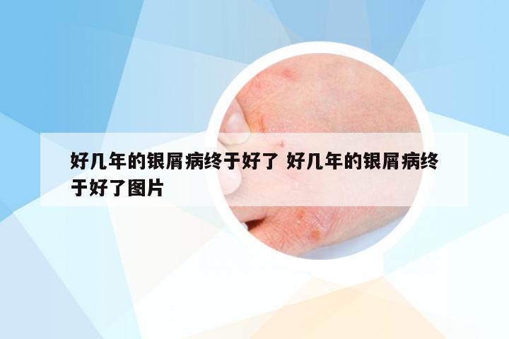 好几年的银屑病终于好了 好几年的银屑病终于好了图片