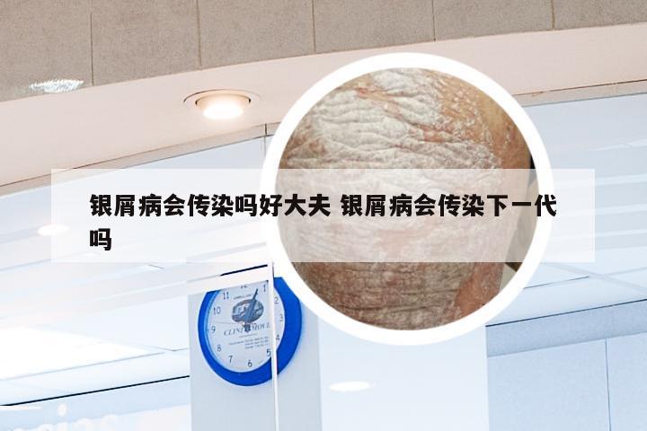 银屑病会传染吗好大夫 银屑病会传染下一代吗