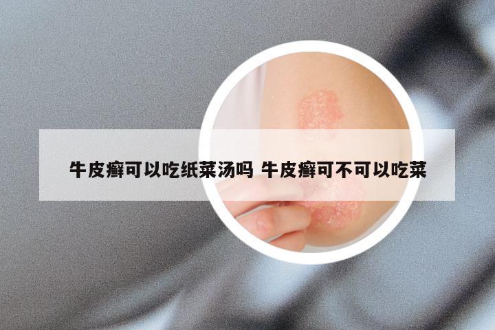 牛皮癣可以吃纸菜汤吗 牛皮癣可不可以吃菜