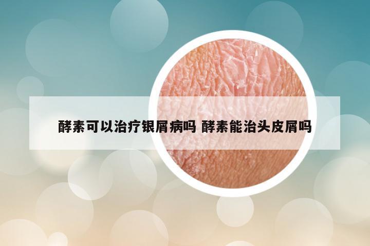 酵素可以治疗银屑病吗 酵素能治头皮屑吗