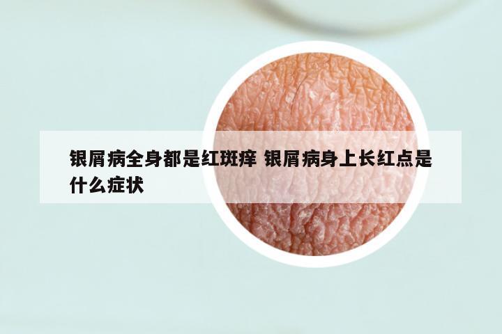 银屑病全身都是红斑痒 银屑病身上长红点是什么症状