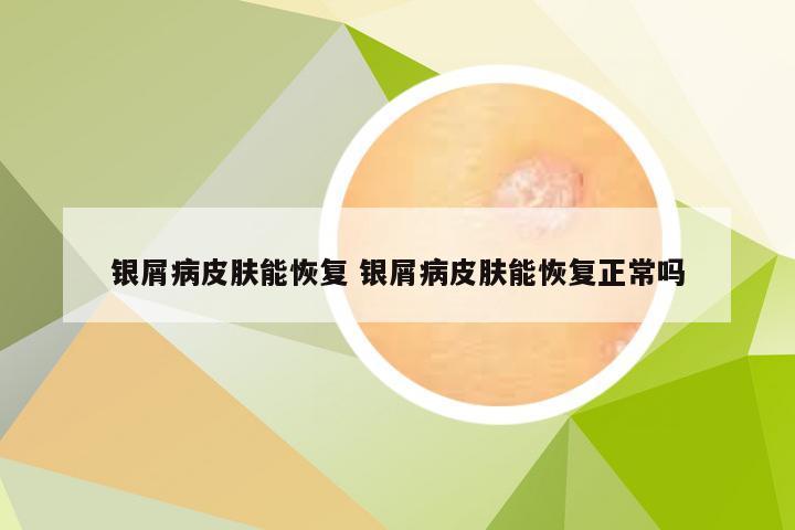 银屑病皮肤能恢复 银屑病皮肤能恢复正常吗