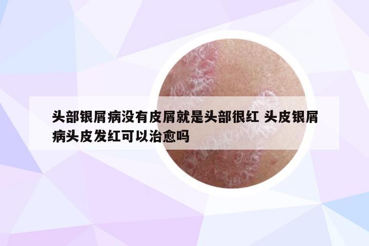 头部银屑病没有皮屑就是头部很红 头皮银屑病头皮发红可以治愈吗