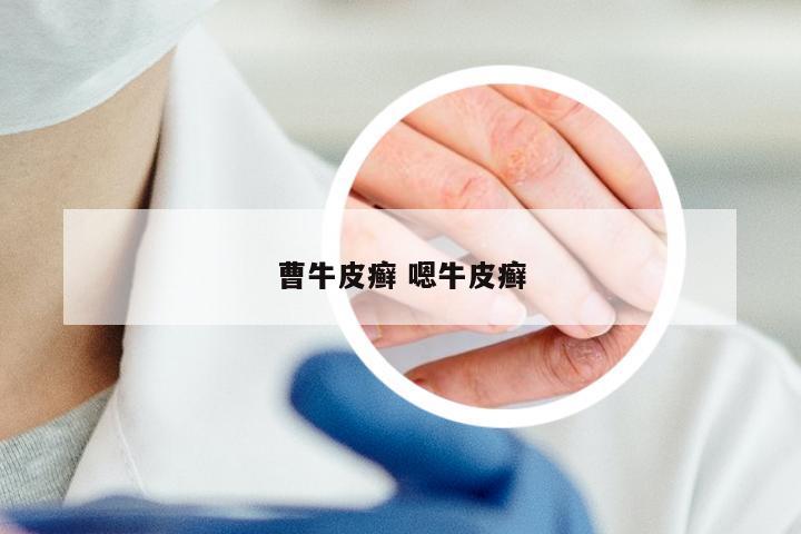 曹牛皮癣 嗯牛皮癣