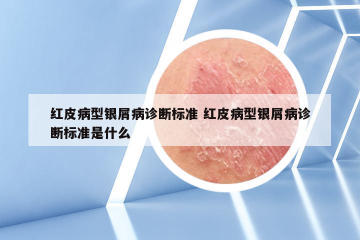 红皮病型银屑病诊断标准 红皮病型银屑病诊断标准是什么