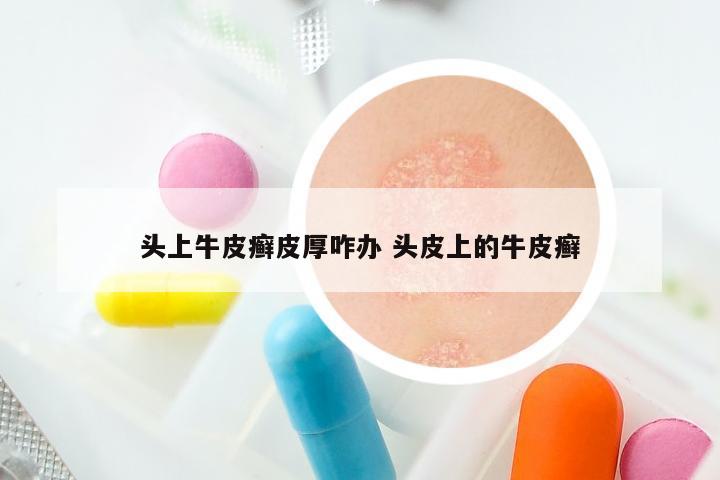 头上牛皮癣皮厚咋办 头皮上的牛皮癣