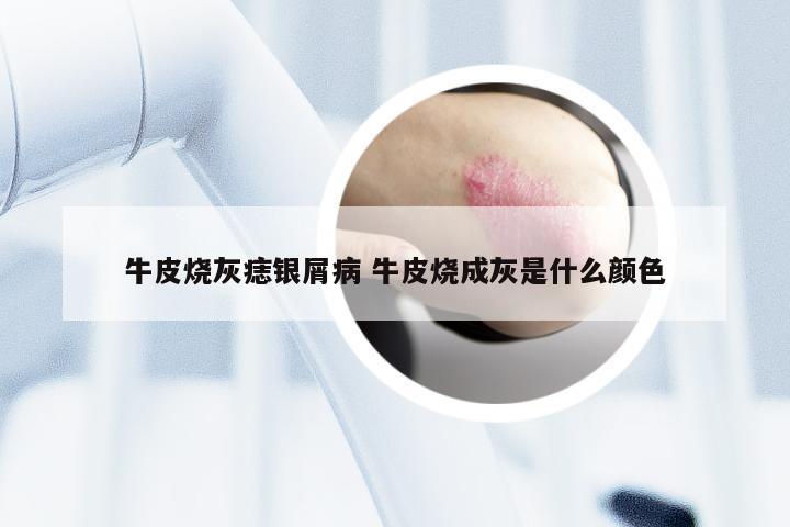 牛皮烧灰痣银屑病 牛皮烧成灰是什么颜色