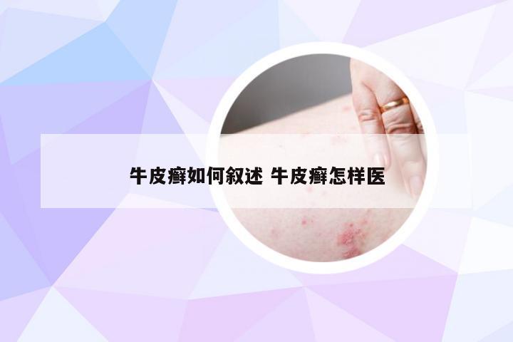 牛皮癣如何叙述 牛皮癣怎样医