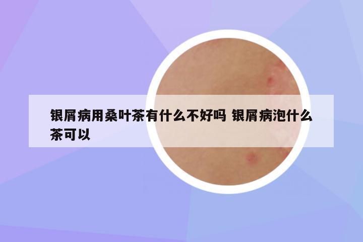 银屑病用桑叶茶有什么不好吗 银屑病泡什么茶可以