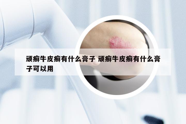 顽癣牛皮癣有什么膏子 顽癣牛皮癣有什么膏子可以用