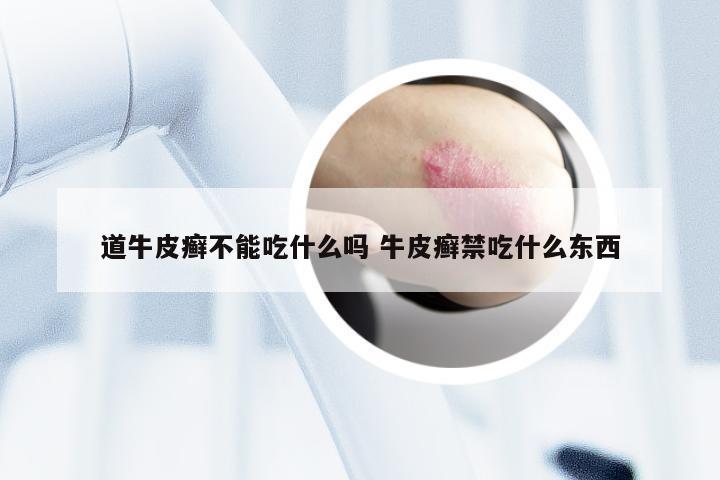 道牛皮癣不能吃什么吗 牛皮癣禁吃什么东西