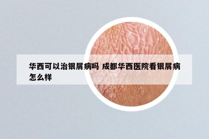 华西可以治银屑病吗 成都华西医院看银屑病怎么样
