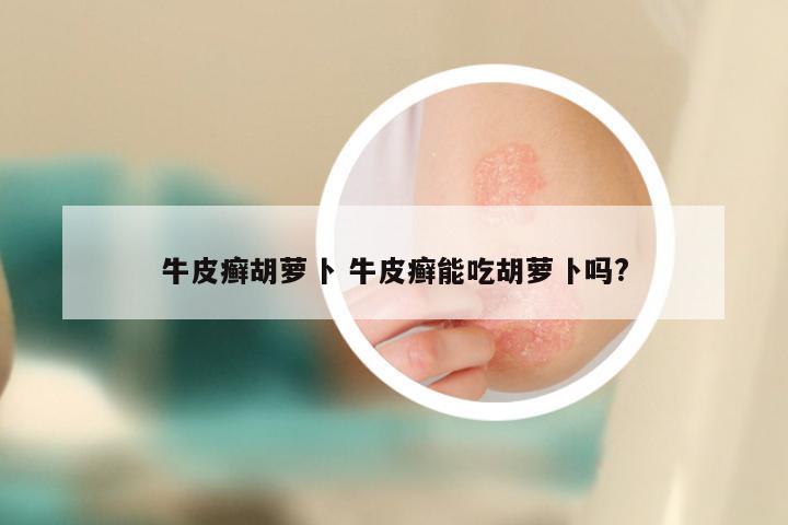牛皮癣胡萝卜 牛皮癣能吃胡萝卜吗?