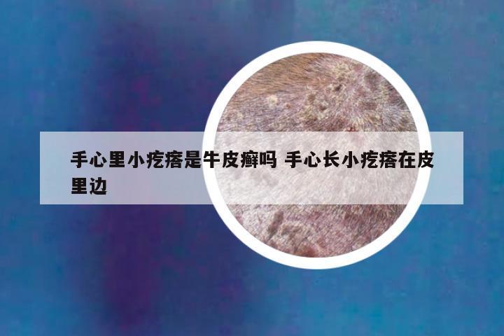 手心里小疙瘩是牛皮癣吗 手心长小疙瘩在皮里边