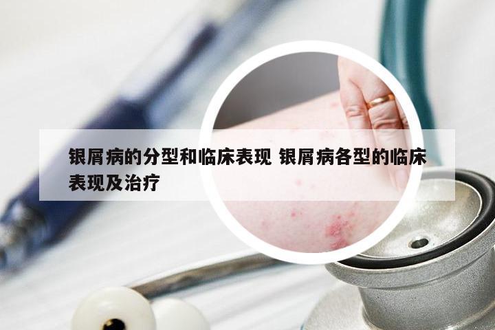 银屑病的分型和临床表现 银屑病各型的临床表现及治疗