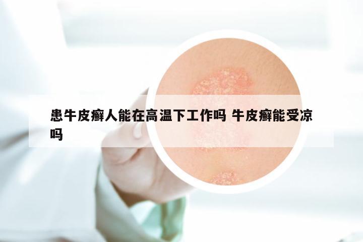 患牛皮癣人能在高温下工作吗 牛皮癣能受凉吗