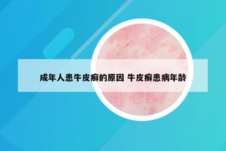 成年人患牛皮癣的原因 牛皮癣患病年龄