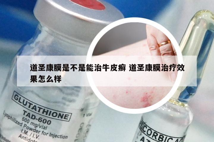 道圣康膜是不是能治牛皮癣 道圣康膜治疗效果怎么样