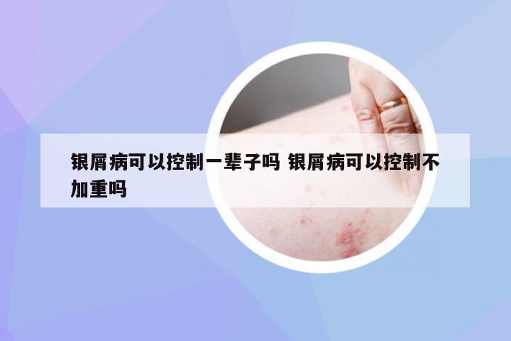 银屑病可以控制一辈子吗 银屑病可以控制不加重吗