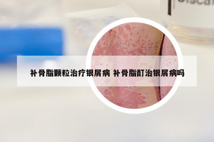 补骨脂颗粒治疗银屑病 补骨脂酊治银屑病吗