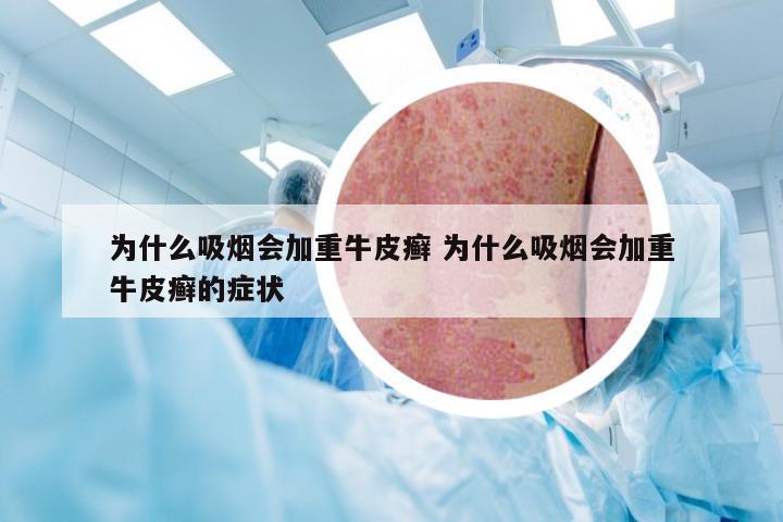 为什么吸烟会加重牛皮癣 为什么吸烟会加重牛皮癣的症状