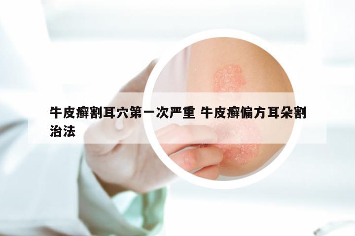 牛皮癣割耳穴第一次严重 牛皮癣偏方耳朵割治法