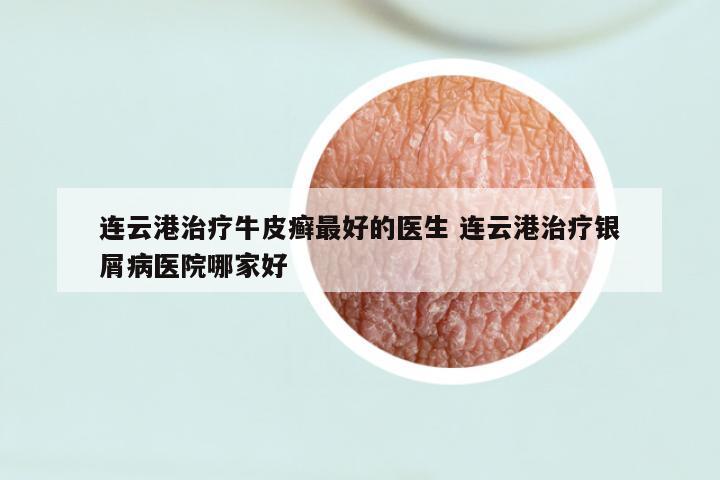 连云港治疗牛皮癣最好的医生 连云港治疗银屑病医院哪家好