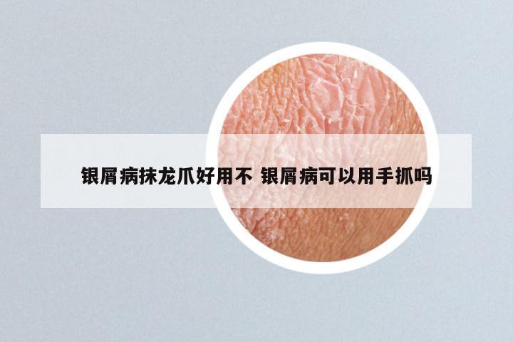 银屑病抹龙爪好用不 银屑病可以用手抓吗