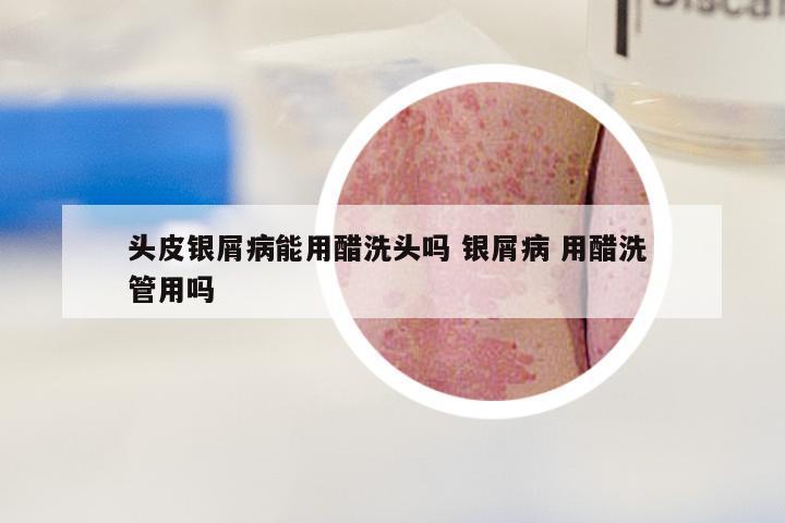 头皮银屑病能用醋洗头吗 银屑病 用醋洗 管用吗